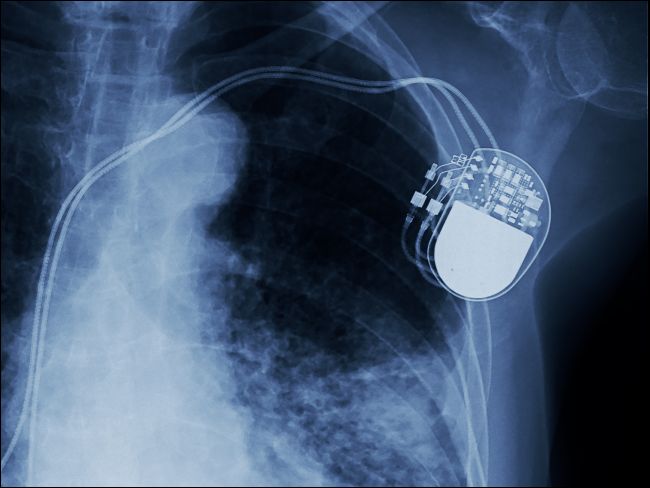 Raio-X mostrando um marcapasso implantado.